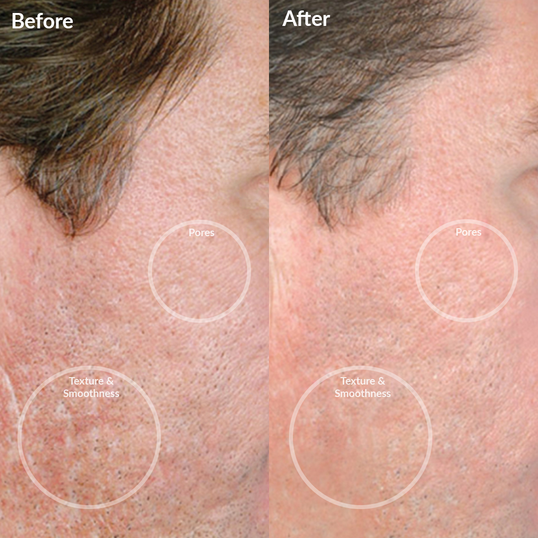 Personal Microderm Elite Pro - Black